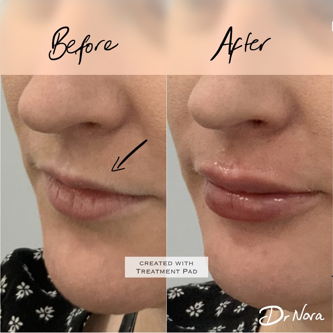 1ml Lip Filler 👄Treatment time is around 20 minutes and swelling and bruising is seen straight after settling at around 3-5 days with optimal results at 2 weeks.
If you’re interested in finding out more or to book, head over to drnora.com.
Take care...