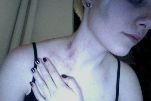 reigning queen of hickies princess of bite marks