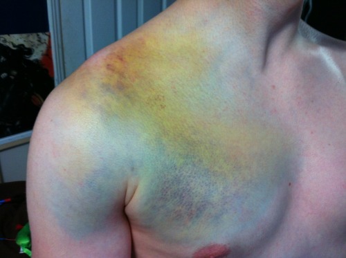 lessons-in-gore:  Bruise from a snowboarding adult photos