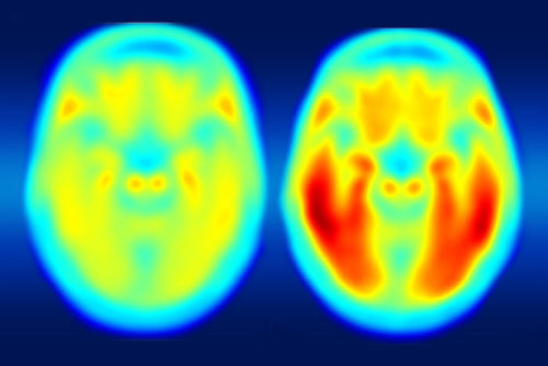 (Image caption: A study using a new PET imaging agent shows that measures of tau protein in the brai