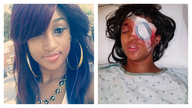 black-culture:  (via Pregnant Woman Dornella Conners Loses Eye from Ferguson Police