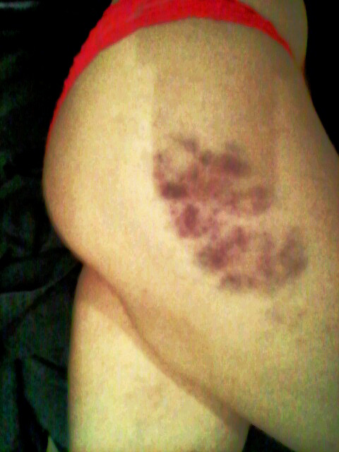 my phone takes shitty phtos, but i just loved my bruises too much not to share ;)