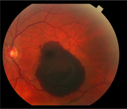 Neurosciencestuff:  Research Points To Promising Treatment For Macular Degeneration
