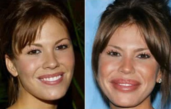 Big lips plastic surgery gone wrong