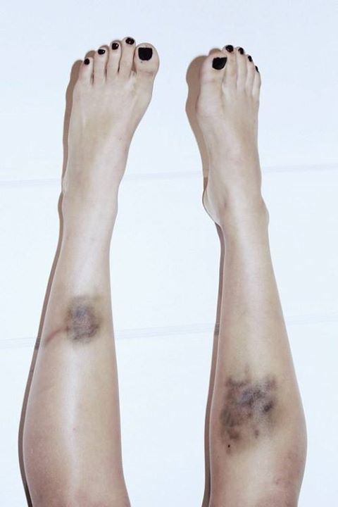 contusions