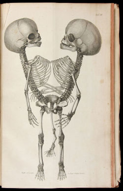 amorbidwitch:  Conjoined Twins, From “Observationes Anatomicae”, Johann Gottlieb Walter; MDCCLXXV