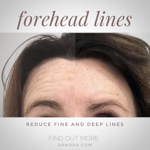 Goodbye forehead lines 👋Is exactly what this beautiful lady is saying after having successful anti-wrinkle treatment across her forehead.
Anti-wrinkle therapy is quick and easy with optimal results at 2 weeks and treatment lasting 3-5 months, you can...