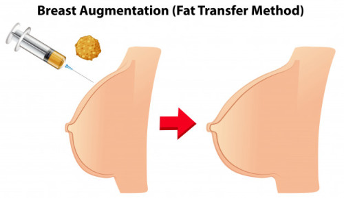 “You may not realize it, but they can now transfer your own body fat to augment your breast si