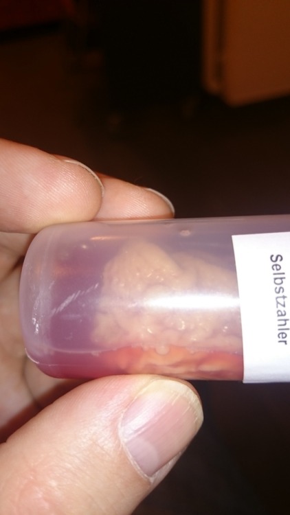 circumcisedperfection:  celticbear-getting-cut:  it is done. My husband is circumcised. I’m waiting for him to wake up.  This is the foreskin in a tube. You can see the bump  Thank fuck it’s cut