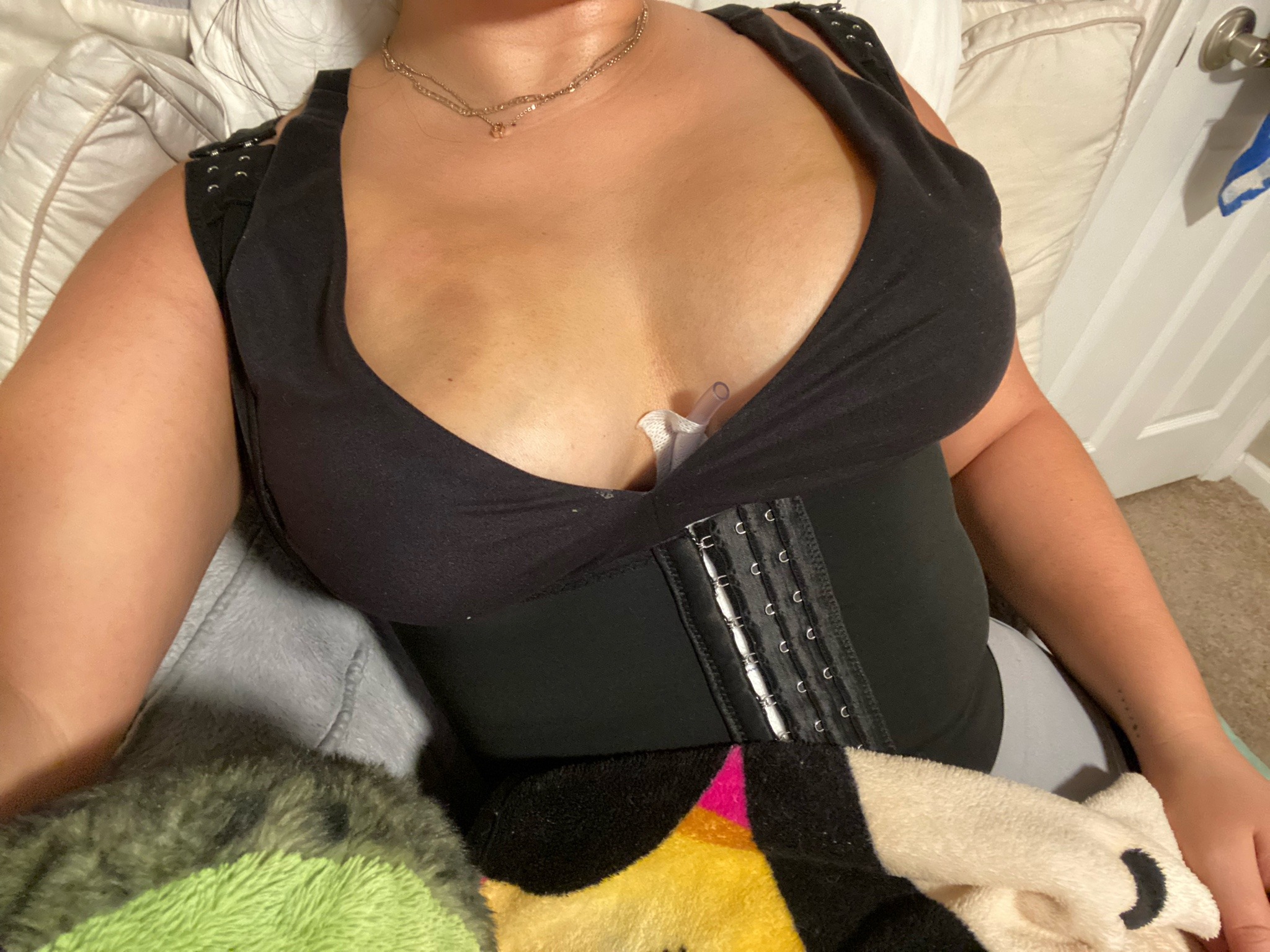 yitties swollen after lipo & fat transfer adult photos