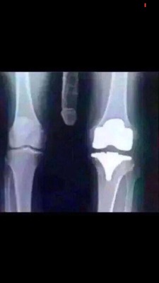 I got my knee X-Rays back ..  The nurse mentioned they where some of the best X-rays she has ever seen