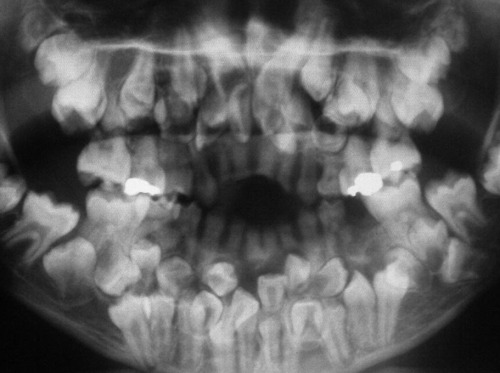 [A]n unusual case of multiple hyperodontia in a girl aged 11 years 8 months with 31 supernumerary te