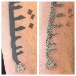 Laser tattoo removal appointments available