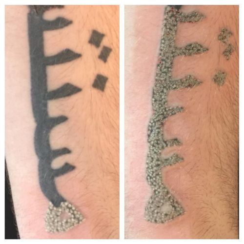 Porn photo Laser tattoo removal appointments available