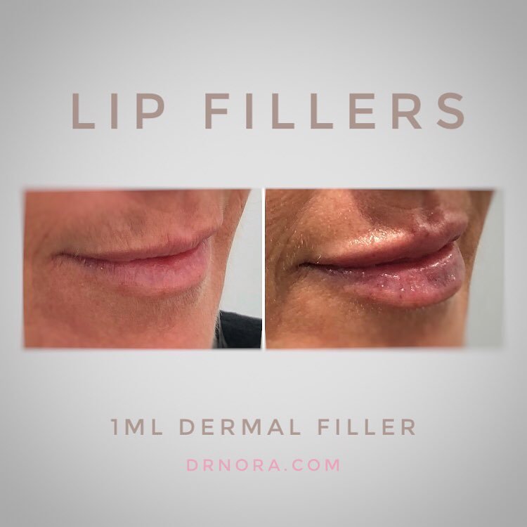 What a difference 1ml can make! 💉This beautiful lady had 1ml of dermal filler in her lips with a fantastic outcome!
Her lips are fuller, plumper and look fabulously hydrated. With results expected to last up to 6 months why not treat yourself 💋
If...