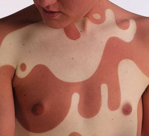 slentando:  xxvampanicxx:  I know how self conscious people can be due to their skin.