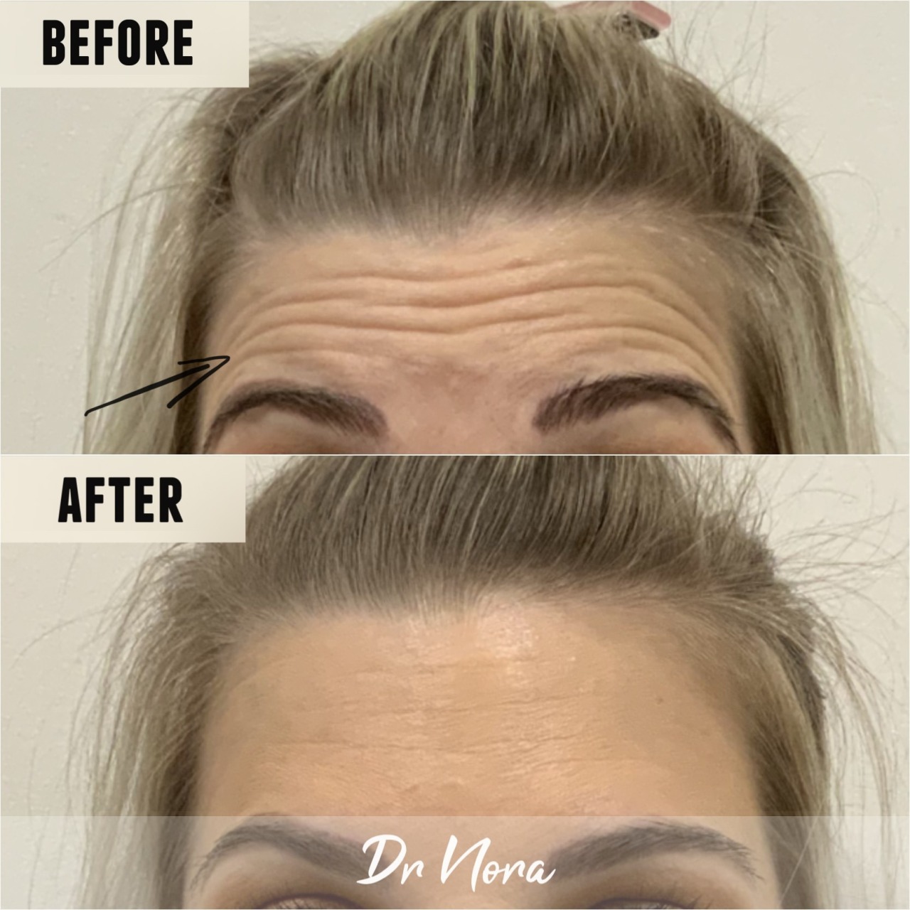 Anti-wrinkle treatment of the forehead ðŸ˜²Anti-wrinkle therapy is a way to reduce the appearance of strong and deep lines. Treatment time is 15 minutes, optimal results are seen at 2 weeks and lasts up to 3-5 months.
If you have any questions or would...