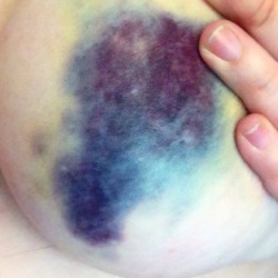 theladypunch:I got into an accident on Monday. Here’s my galaxy boob bruise, which I figured Tumblr would like.