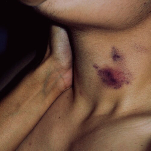 Hickeys. porn pictures