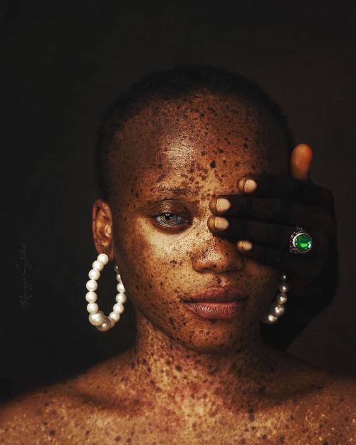 checkoutafrica:  VITILIGO 🖤  Photography