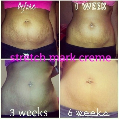 Stretch marks before and after weight loss