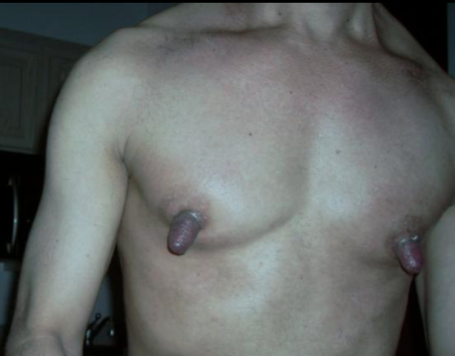 nipplesofthegods:Perfect gay nipple enlargement! This should be the goal for all gay nipple pumping!