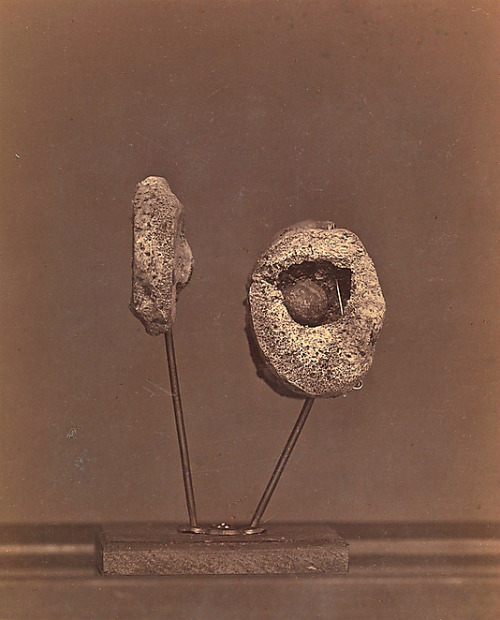 thecivilwarparlor:Excised Knee Joint. A Round Musket Ball in the Inner Condyle of the Right Femur [G