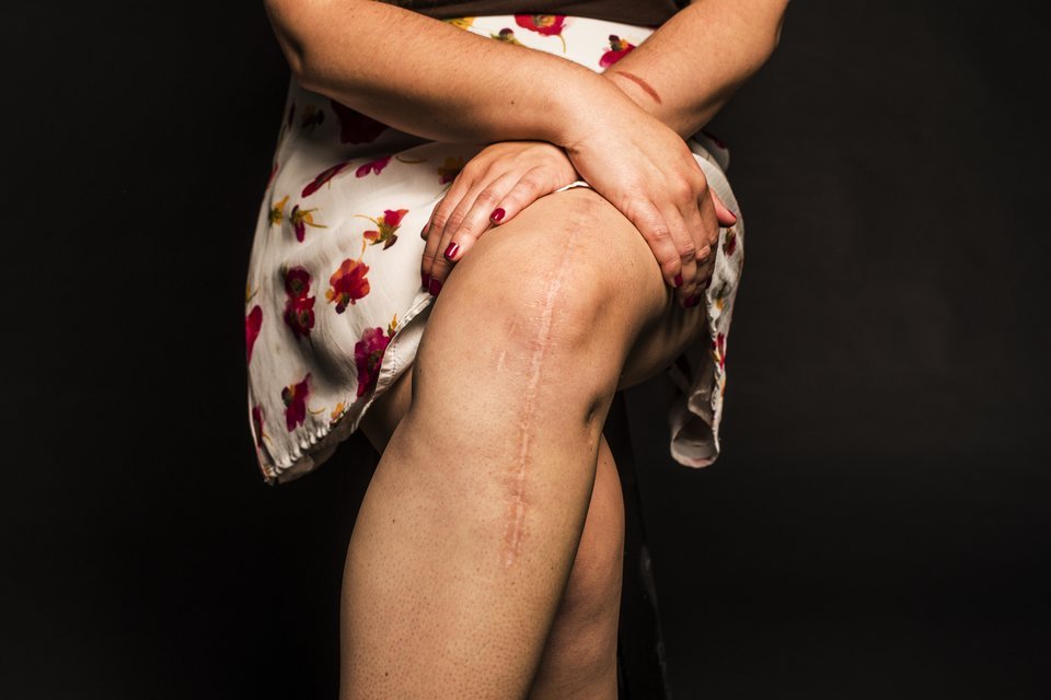 huffingtonpost:  24 Women Bare Their Scars To Reveal The Beauty In Imperfections“It’s