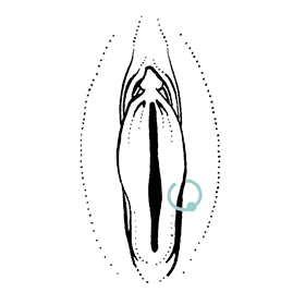 Vulva piercing
