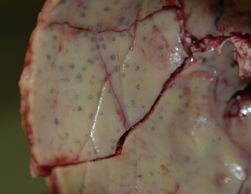 Impact Sites Of Lead Pellets On The Inner Table Of A Skull Due To A Shotgun Wound To The Head.