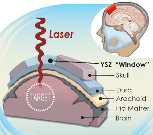 University of California Researchers Develop Transparent Skull Implant to Facilitate Laser-Based Brain Treatments
The team’s implant is made of the same ceramic material currently used in hip implants and dental crowns, yttria-stabilized zirconia...