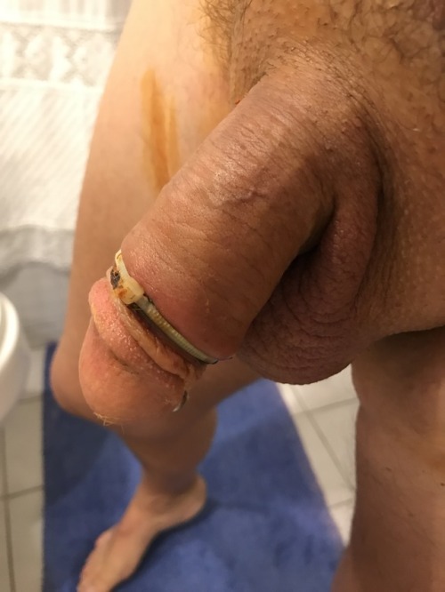 swamigay:  Day 5 officially circumcised Eeeehhhhhhhh LOL :) Auto Circuncisión  Self Circumcision  