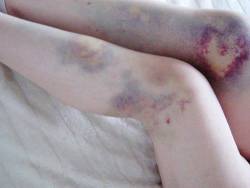 cwissi:  Bruises are so cute