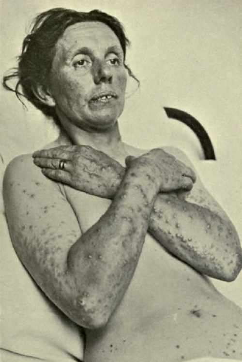 A Sufferer of Smallpoxold photograph of an unidentified smallpox sufferer that comes from my copy of