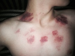 lovelycontusions:  Just a couple of small hickies.