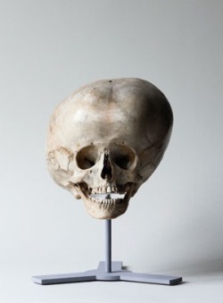 necromancynancy:  Hydrocephalic skull, 19th