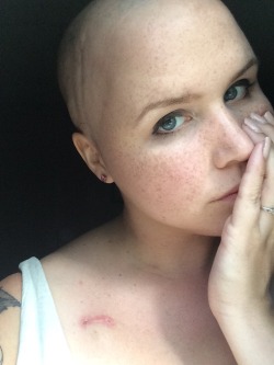 sittenlos:  prettylittleswitch:  lady-neurotica:  Cancer selfies 💕 bloat, uneven baldness, pale skin/pronounced port scar.  It’s good though. I’m okay with this me  You’re so perfect.   omg, perfect. 