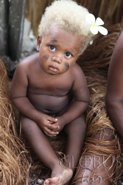 coolthingoftheday:  People with unusual phenotypes. 