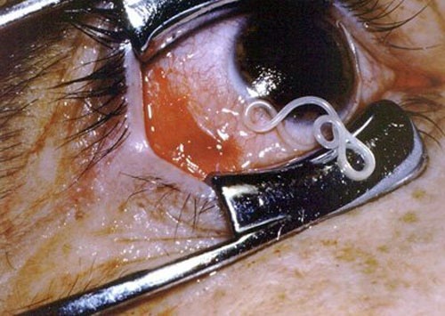 Filarial Worm, a horrible parasite that can live in your eye. Even worse, there are