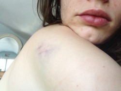 somersetnom:  How did I get this bruise?