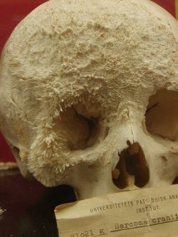 xbabystaybeautifulx:   Bone cancer shown on skull.  This is terrifying 