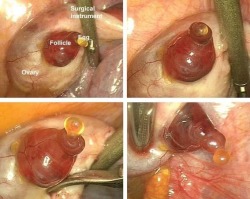 medicine-nerd:  modernathena90:  medicine-nerd:  this-nursing-life:  silverstars87:  umbillicus:  Here, the moment of ovulation was accidentally witnessed during a robotic surgery. Previously, ovulation was thought to be a sudden pop but this actually