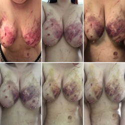poppabear47:  Bruise progression collage from @inquisitorialfox she marks so wonderfully