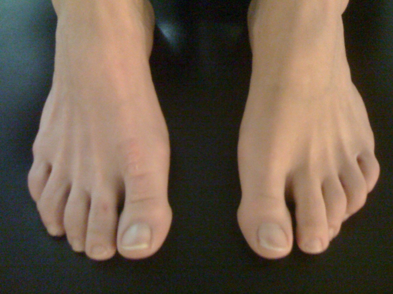 Do toes curl why Toe cramps: