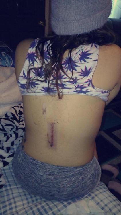 Fractured three bones in my spine being a passenger with no seatbeltin a roll over accident on the f
