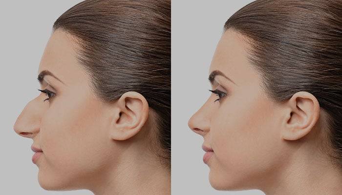 Turkey Nose Job / 8 Nose Job Turkey Before And After Pictures Ideas Rhinoplasty Surgery Nose Job