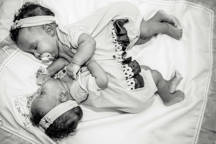 sixpenceee:  Conjoined infants survive life-Or-death SurgeryThe twin infants, Maria