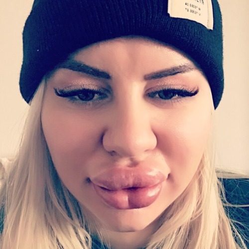 natasha-crown-official:It’s not only the booty that is growing on me#Botox #lips #duckface #natashac