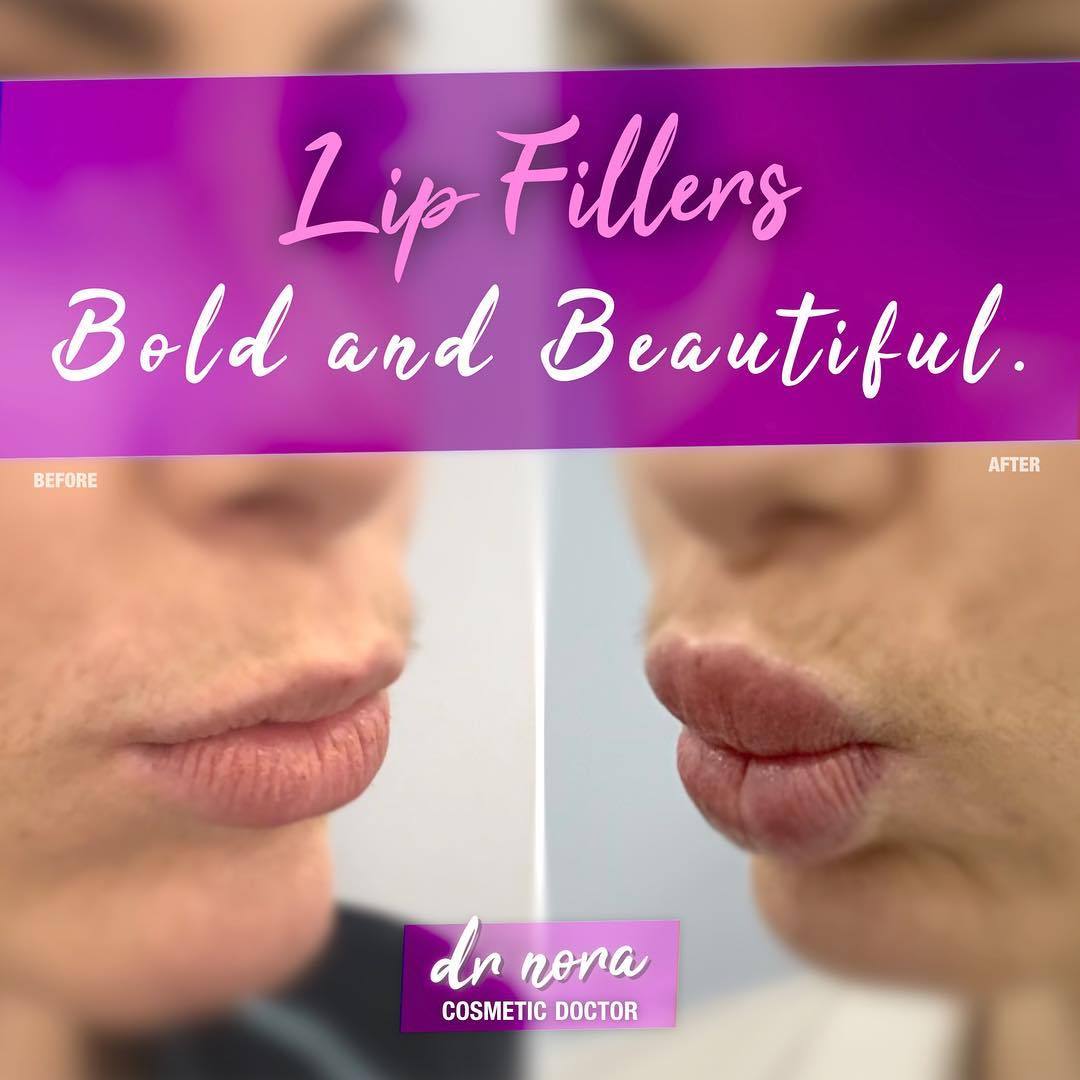 Give your lips some drama this Australia Day ππ¦πΊ This beauty’s pout has had a dramatic makeover with two millilitres of dermal filler over consecutive treatments and the results are bold and beautiful πIf you’re interested in finding out more please...