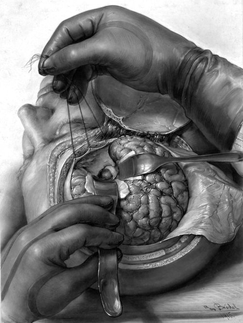 Intraoperative exposure with the frontal lobe retracted, 1915. From Dr. George J. Heuer: Arch Surg 1